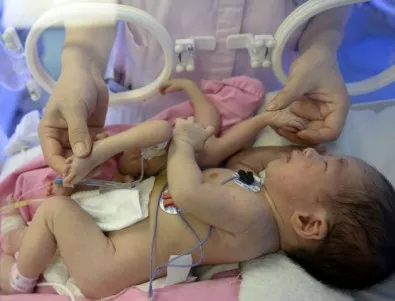 Бебе с осем крайника стресна доктори в Китай
