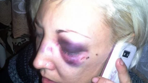 Бита до неузнаваемост жена не отива на детектор на лъжата - не вярва на МВР