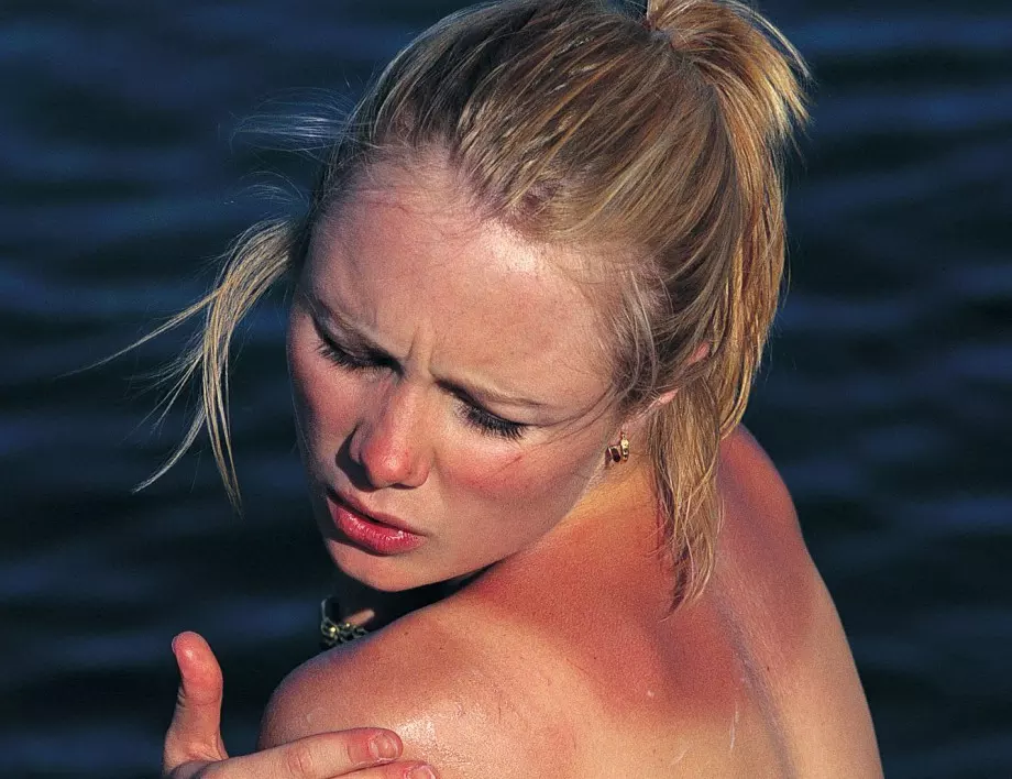 Ето как да успокоим изгорялата кожа - лесни трикове за бързо облекчаване на болката
