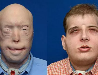Мъж получи ново лице в най-сложната трансплантация