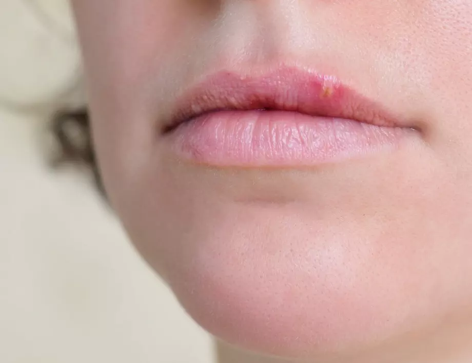Предположение: Обрив в устата може да е симптом на COVID-19?