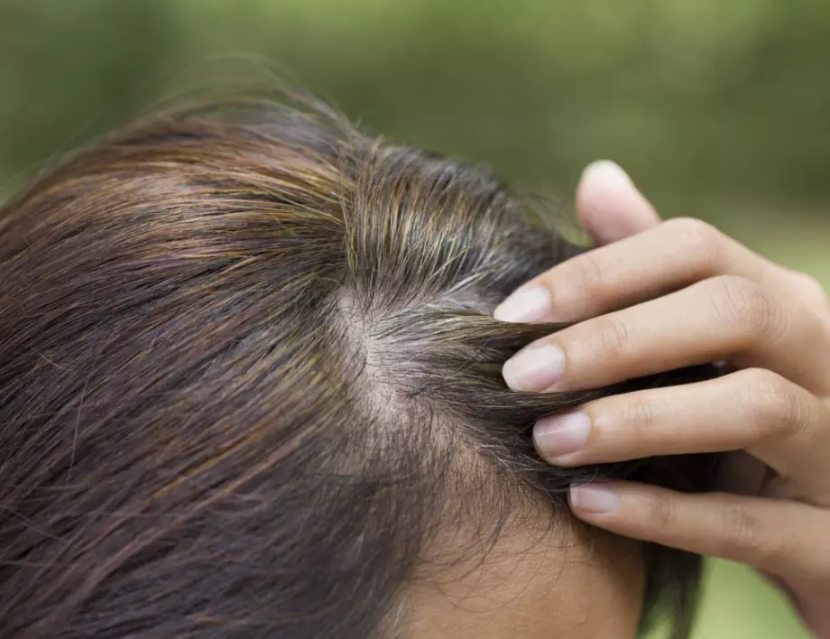 За какви заболявания сигнализира ранното посивяване на косата