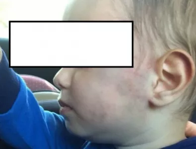 Дете беше прибрано от детска градина с огромни синини по лицето