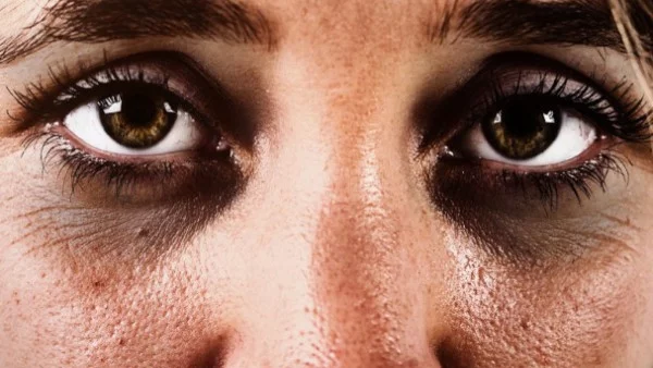 Тъмни кръгове под очите ? Ето причините