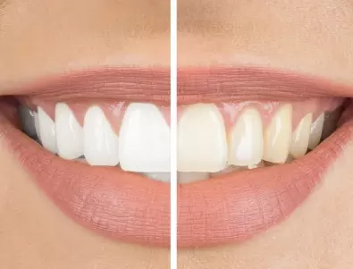 Как да се преборим с жълтите зъби?