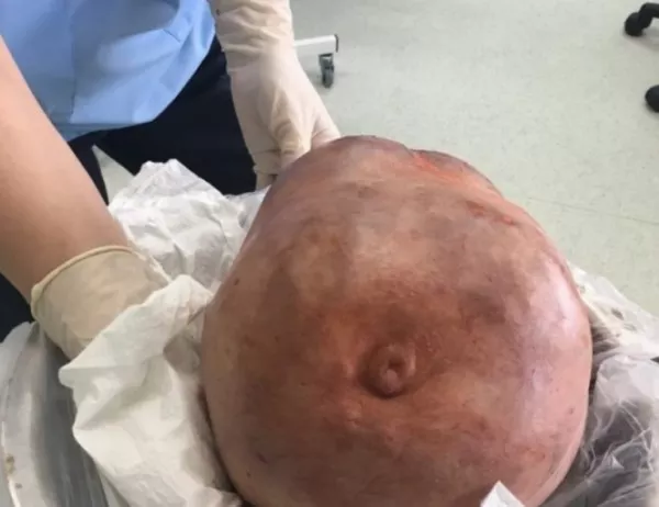 Премахнаха тумор с тегло десет килограма от гърдата на жена