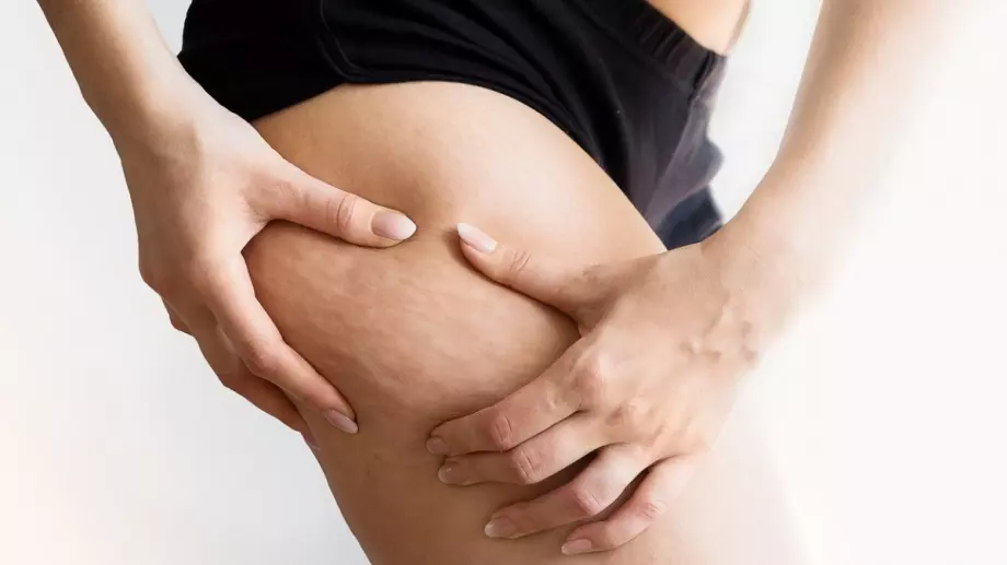 Плодовете и зеленчуците, които се препоръчват при целулит