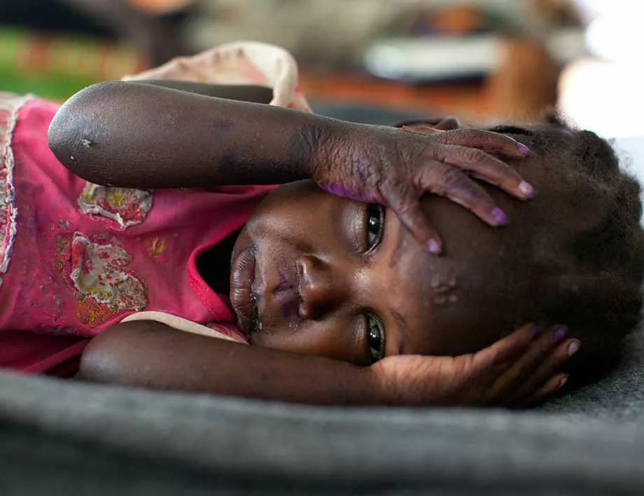 Над 30% от децата в света са недохранени или затлъстели 
