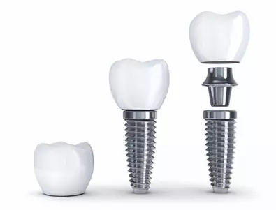 Неподозираните предимства на лечението със зъбни импланти
