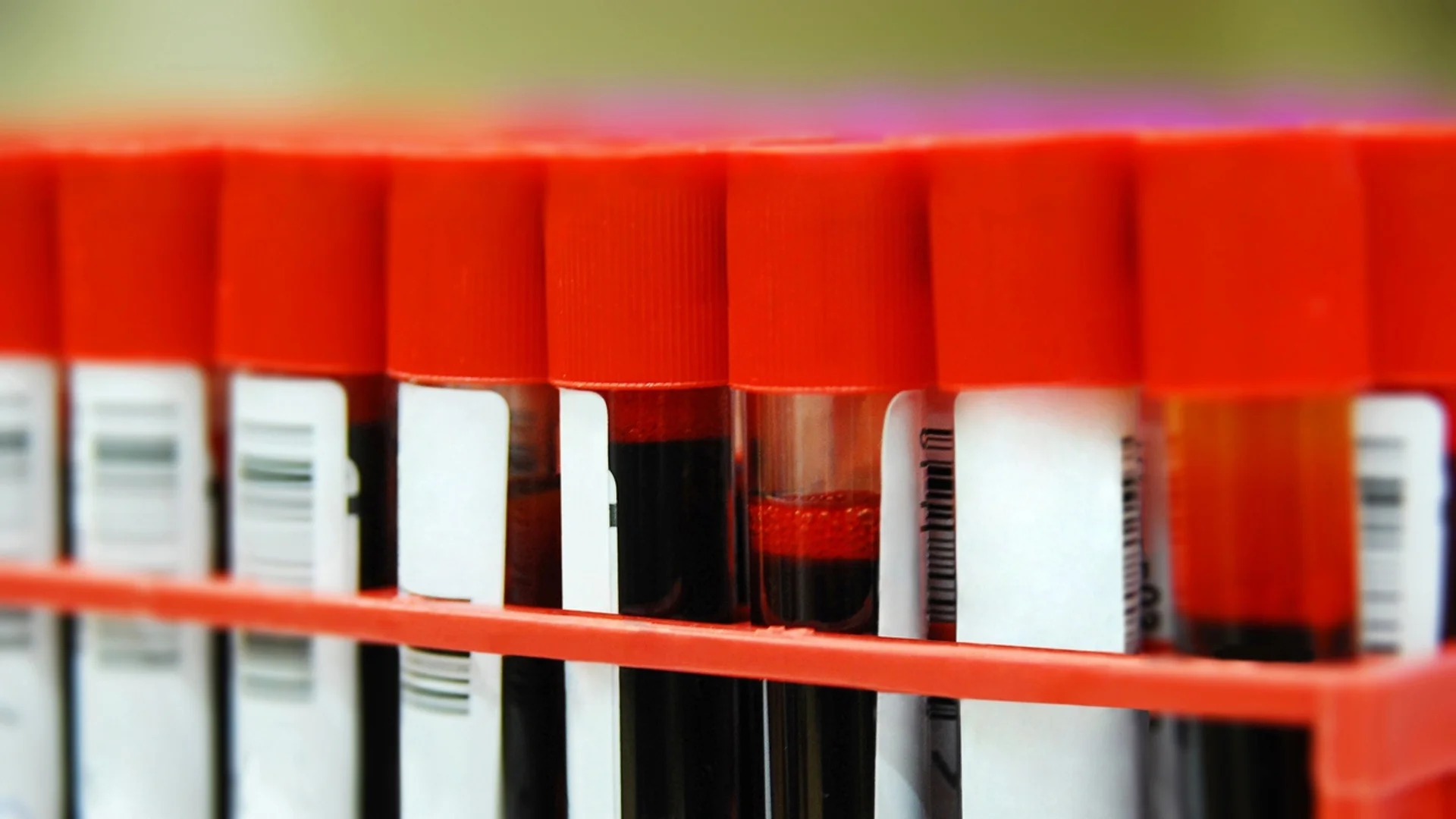 Учени: Хората с тази кръвна група са с най-висок риск от ранен инсулт