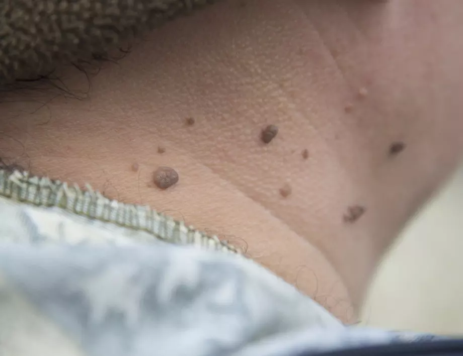 Как сами да премахнете папиломите по кожата си