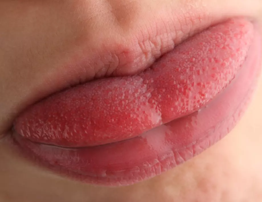 Погледнете езика си и ще разберете болни ли сте от COVID-19 (СНИМКА)