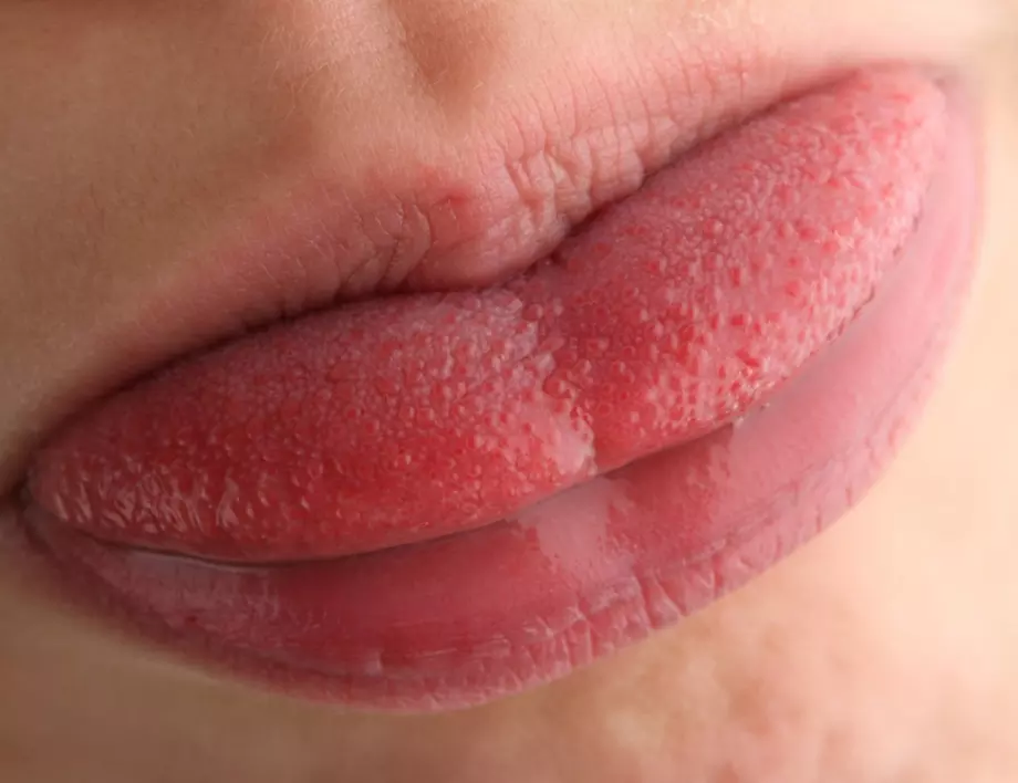 Погледнете езика си и ще научите много за здравето си