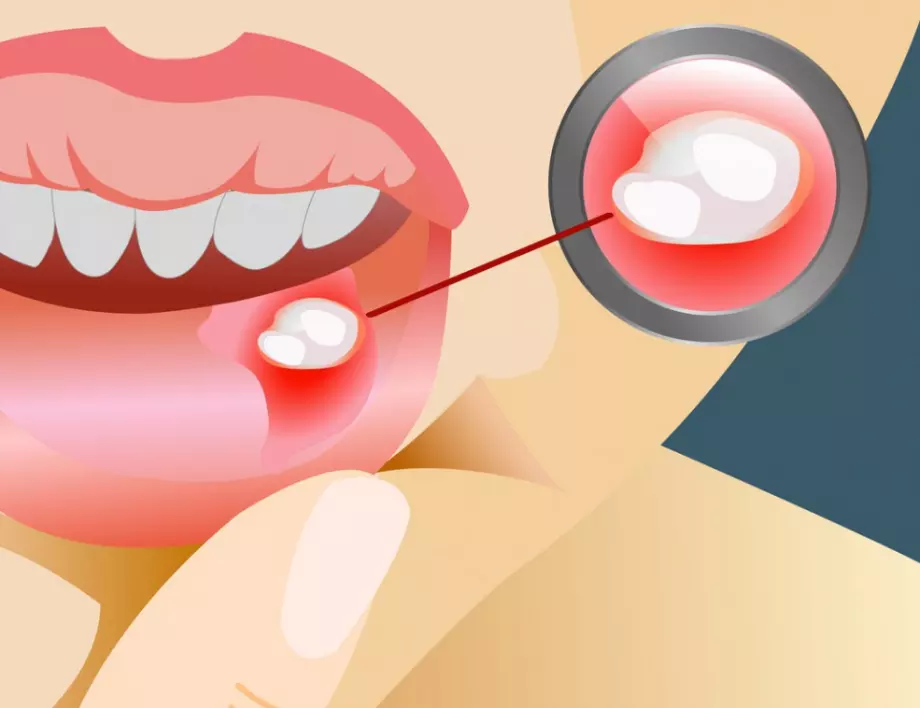 Афти в устата: 6 лесни и ефективни домашни средства за успокояване на болката и дискомфорта