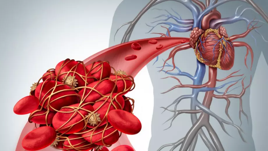 Лекар каза каква е разликата между тромбоза и емболия - всеки трябва да знае това