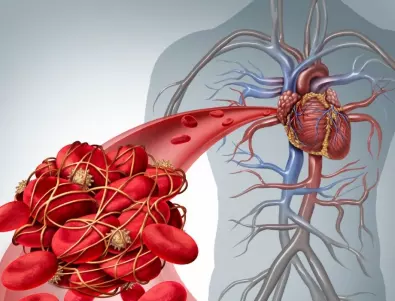 Кръвни съсиреци: 3 симптома, че те застрашават живота ви