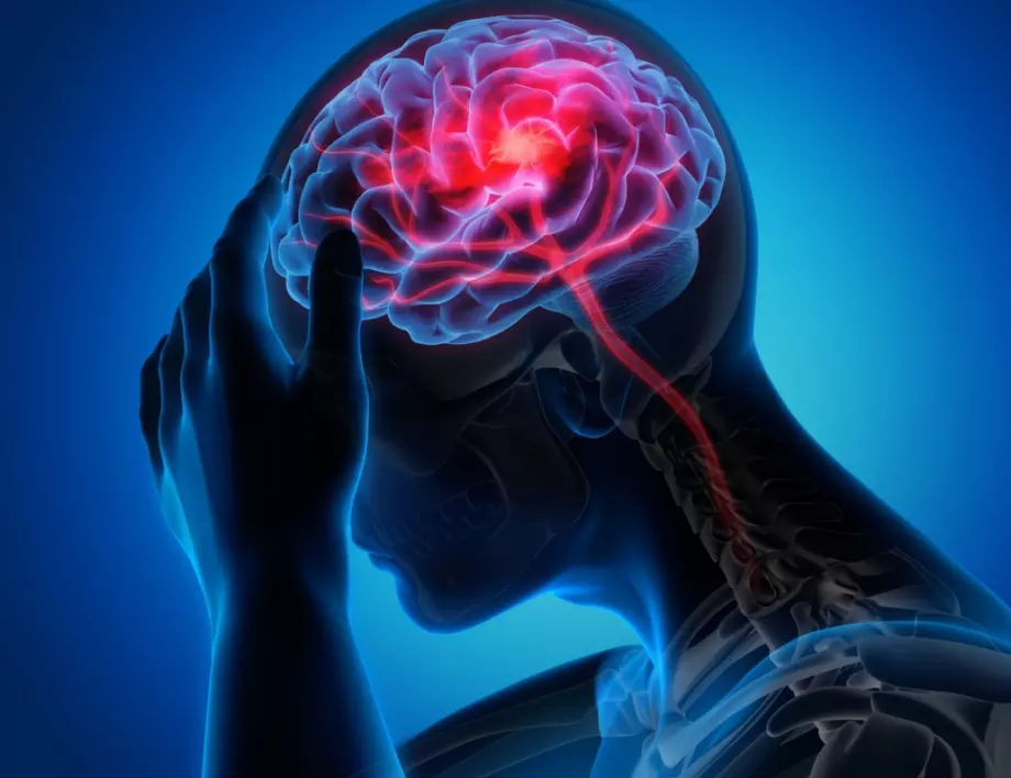 Главоболие или инсулт – 4 важни разлики