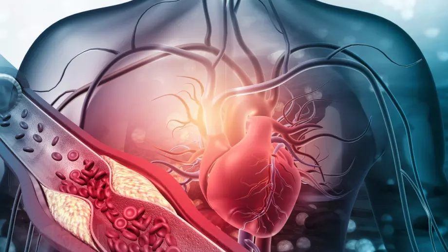 Лекар разкри как кръвното издава висок холестерол и плаки в съдовете