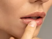 Напукани ъгълчета на устните – за какво алармират?