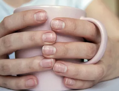 Защо се появяват бели петна по ноктите и с какво се свързват?