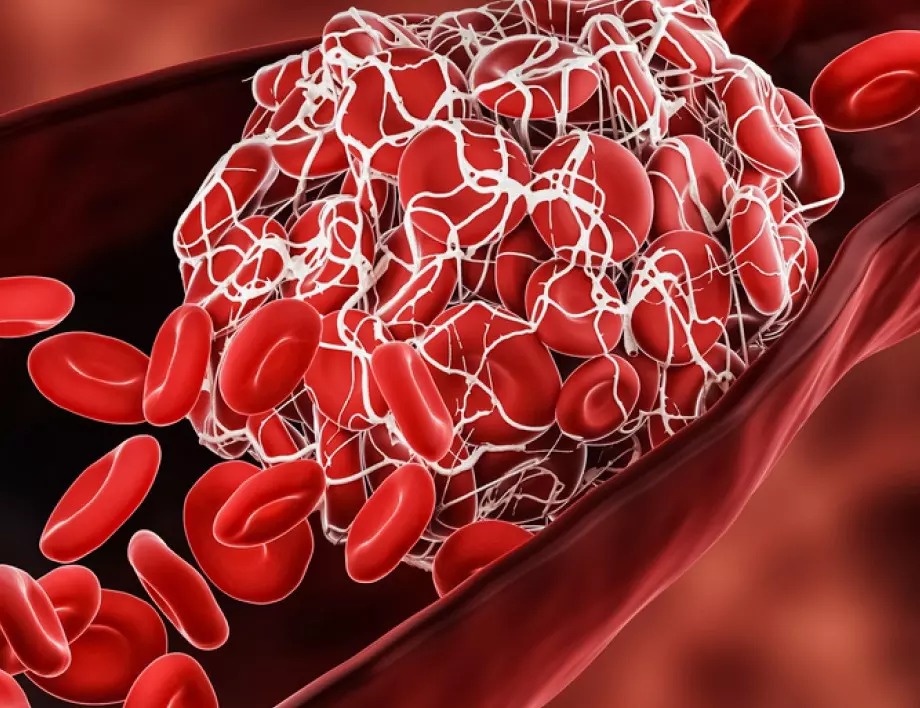 Лекар: НЕ яжте тези 3 храни, за да намалите риска от кръвни съсиреци