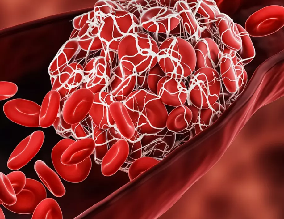 Това са най-лесните начини за разтваряне на кръвни съсиреци