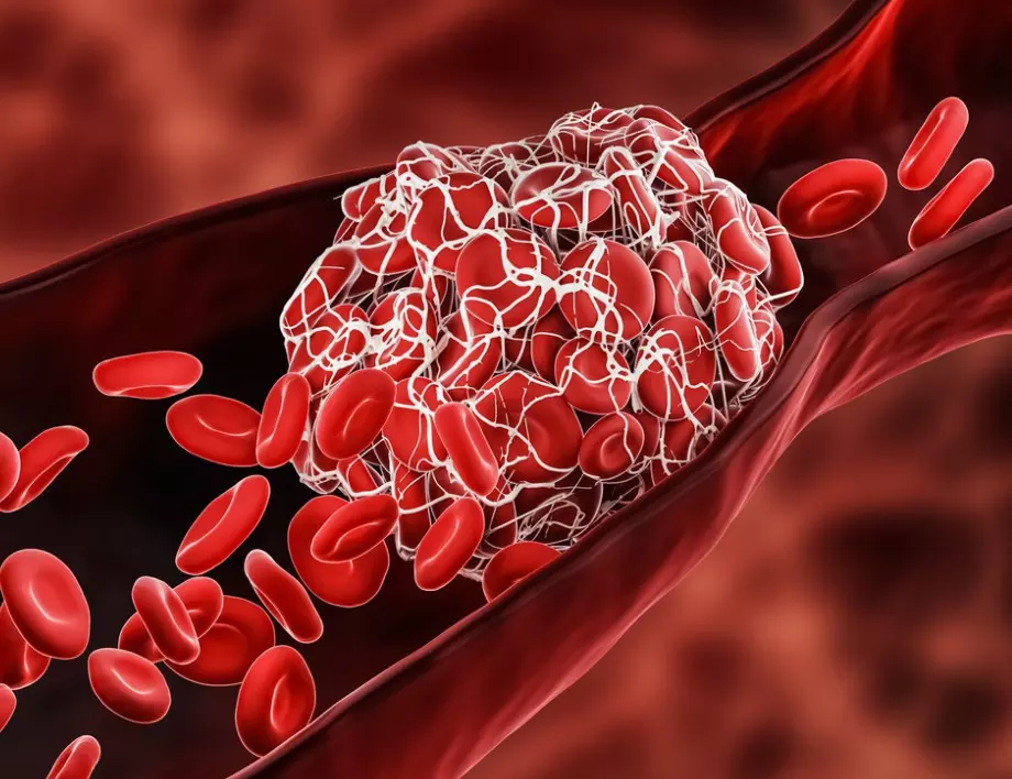 Хирург каза кой е първият симптом за поява на тромб на крак или ръка