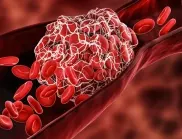 Кардиолог: Първите симптоми на кръвни съсиреци се появяват в тези части на тялото