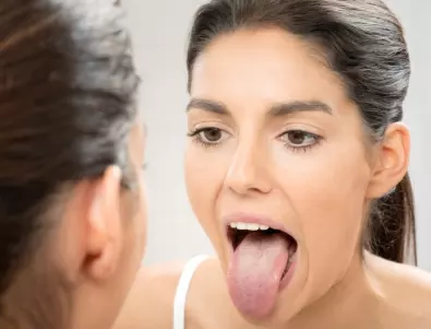 Какво означава бялата плака по езика? Симптомите могат да бъдат тревожни