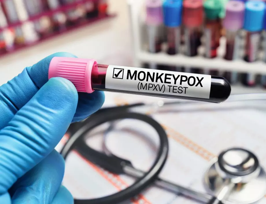Обединеното кралство предупреди за разрастване на маймунската шарка