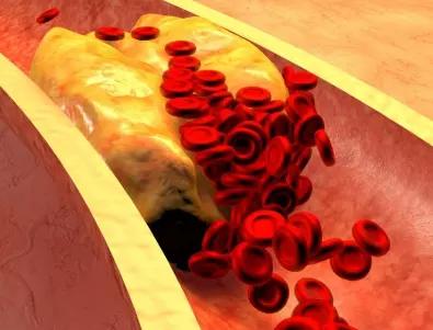 Учени: 4 лъжици от това на ден отпушват артериите