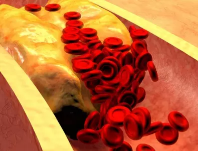 Учени: Едва ли предполагате, че тези симптоми издават запушени артерии