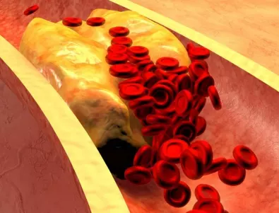 Учени направиха изненадващо откритие за продължителността на живота при хората с висок холестерол