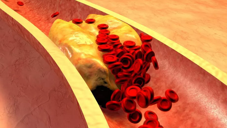 Учени направиха изненадващо откритие за продължителността на живота при хората с висок холестерол
