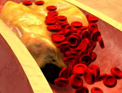 Кардиолог: 2 лъжици от това сваля холестерола за часове
