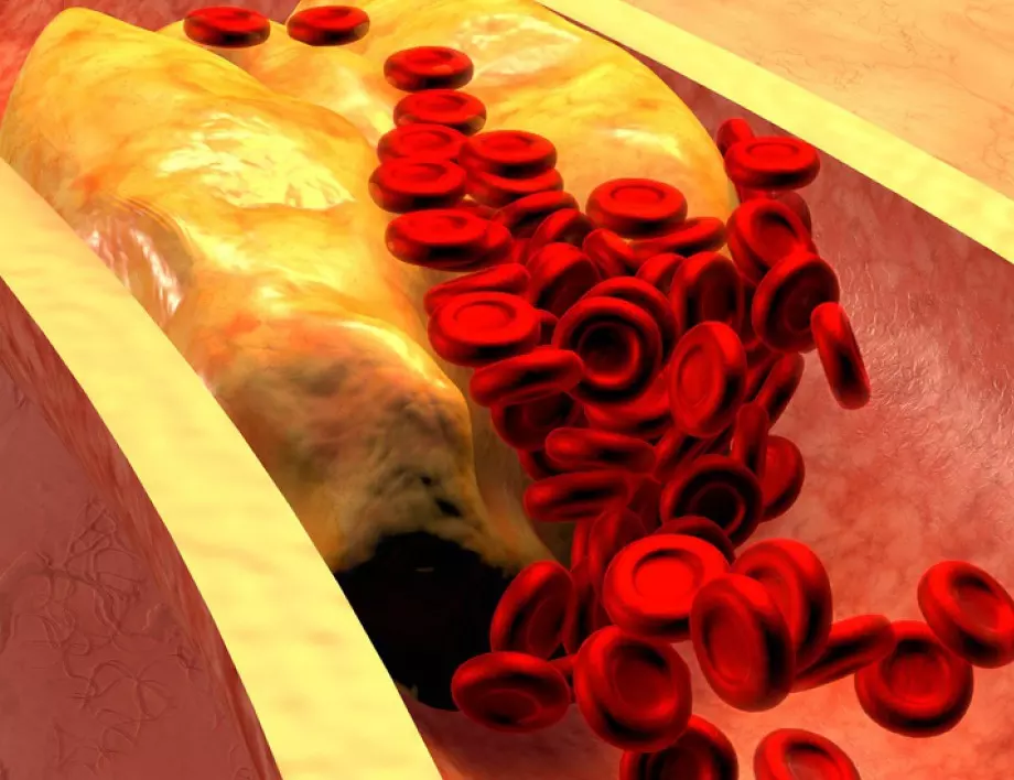 Кардиолог: 2 лъжици от това сваля холестерола за часове