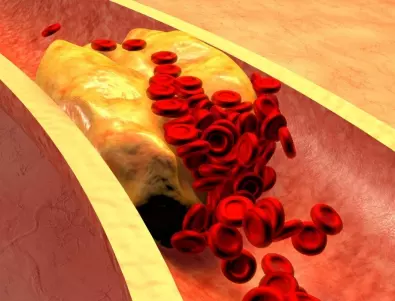 Холестерол: На каква възраст трябва да започне измерването на нивата му