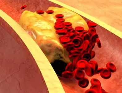 Висок холестерол при жените над 50 години: Кои са най-добрите храни