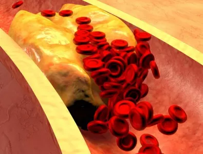 Лекар разкри какво ще се случи с холестерола ви, ако откажете захарта
