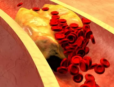 Кардиолог разкри как да свалите холестерола без да се отказвате от любимите си храни