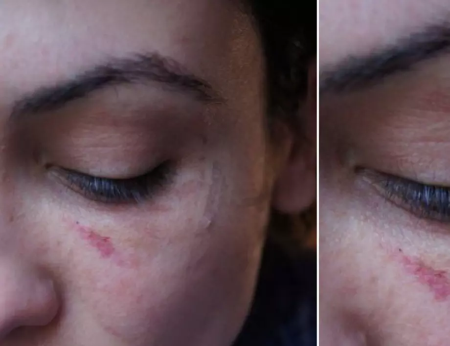 Диана Димитрова показа нови снимки на лицето ѝ със следа от грайфер (СНИМКИ)