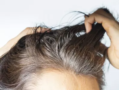 Лекар: Тези 3 заболявания са причината за ранно побеляване на косата
