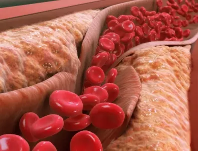 Висок холестерол: Лекар разкри как да го разпознаете по лицето
