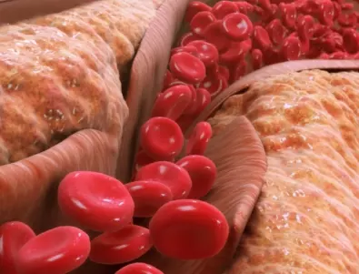 Кръвни съсиреци: Лекар разкри храните, които блокират развитието им