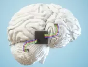 Има проблеми с мозъчния чип на Neuralink, имплантиран в човек 