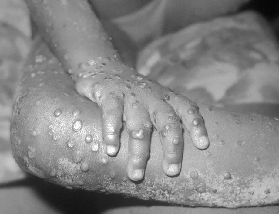 Първи смъртен случай от вируса Alaskapox