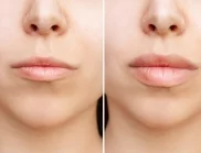 Филъри за устни: Всичко, което трябва да знаете за процедурата