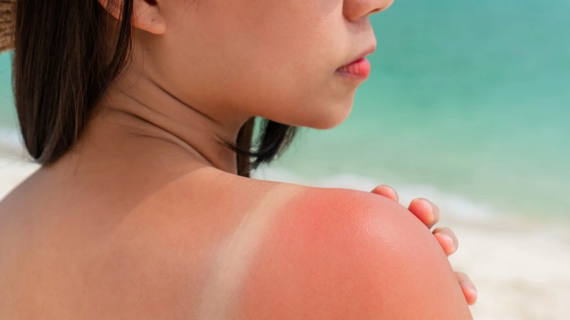 Как да преборим беленето на кожата след слънчево изгаряне?