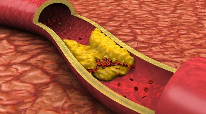 Кардиолог: Това е най-ефикасният начин да премахнете плаката от артериите
