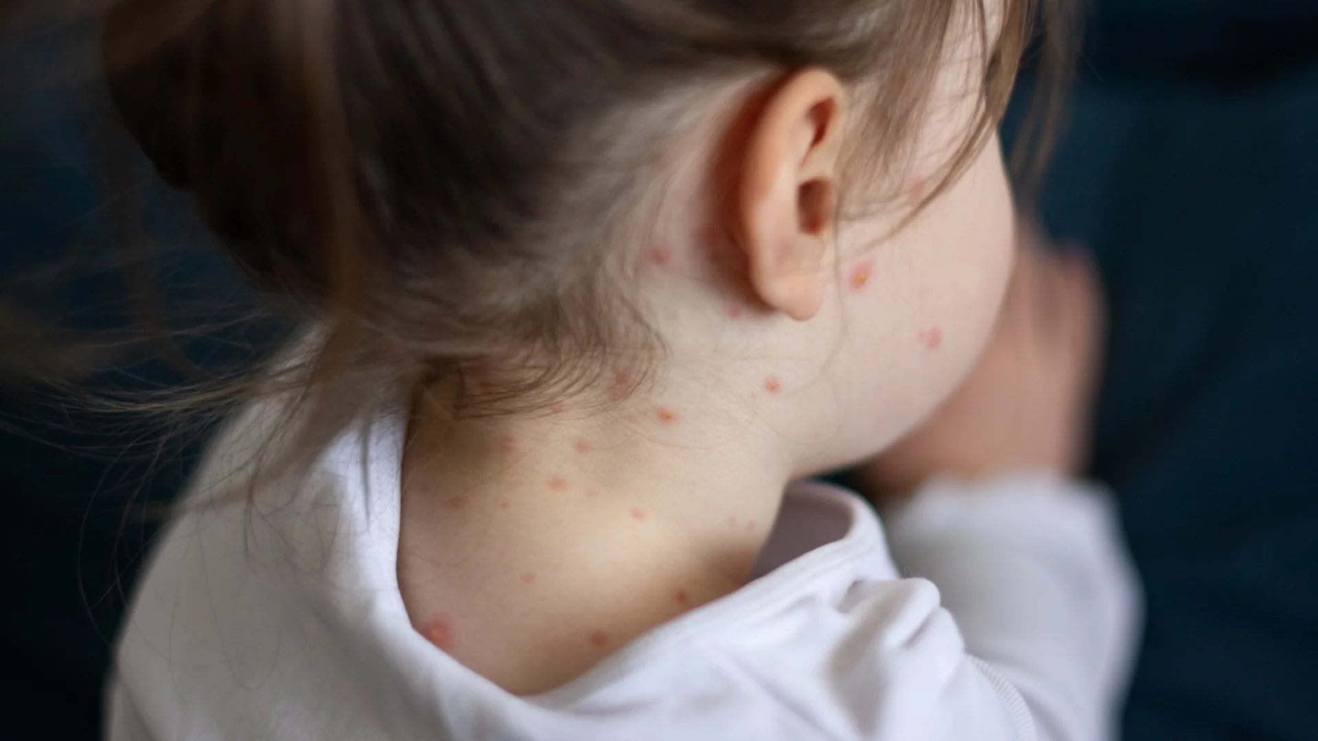 Ваксината срещу варицела става задължителна, държавата ще вади милиони за нужните количества